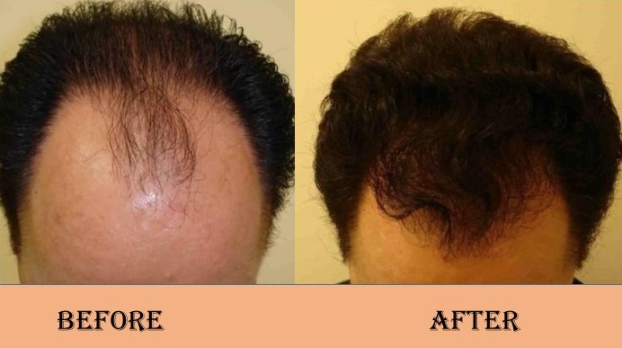 Best hair transplant in south delhi