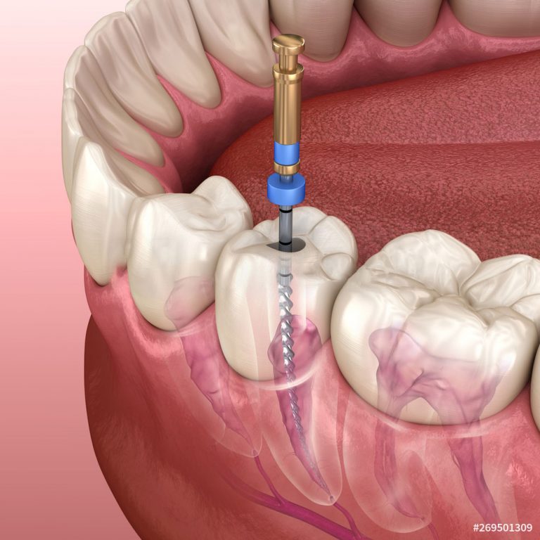 Best Root Canal Treatment in GK1