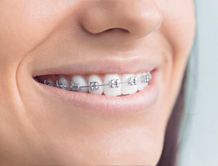 Dental Braces in South Delhi