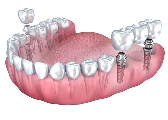 Best crown and bridges on implants in delhi