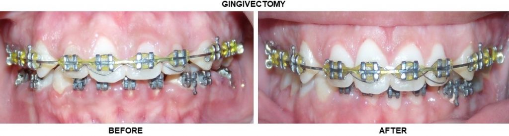 Best gingivectomy in south delhi