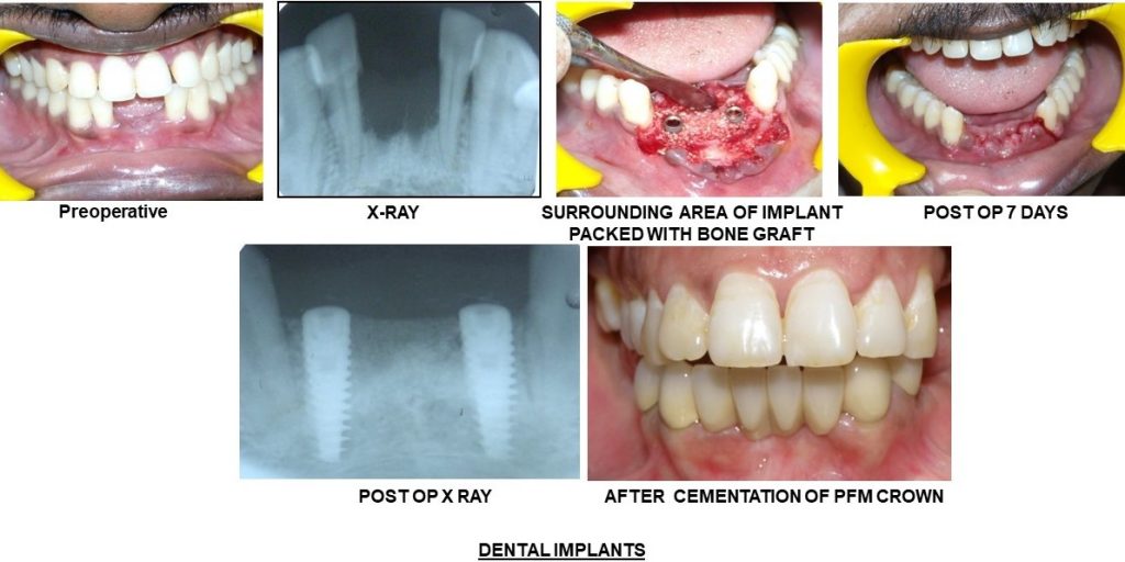 Best implant in gk1 dental