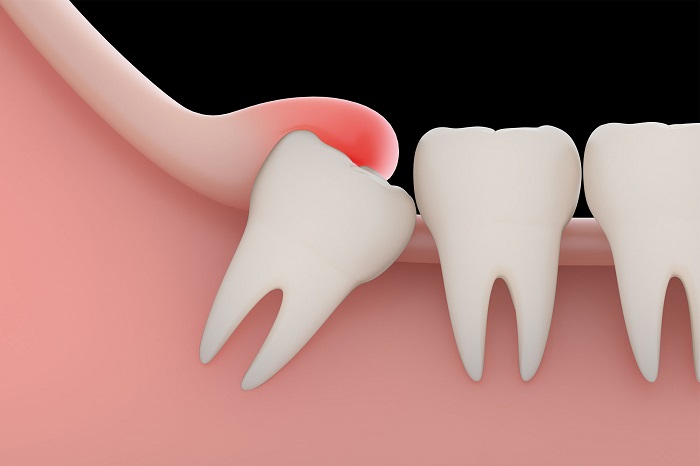 Best Impacted Wisdom Teeth in south delhi