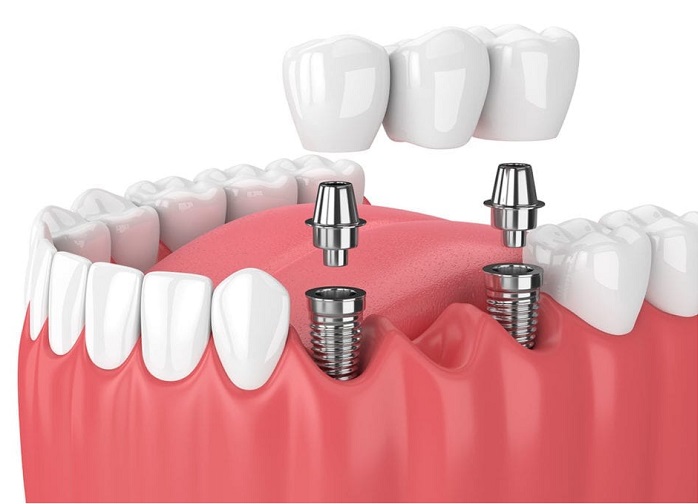 Best multiple teeth implants in delhi