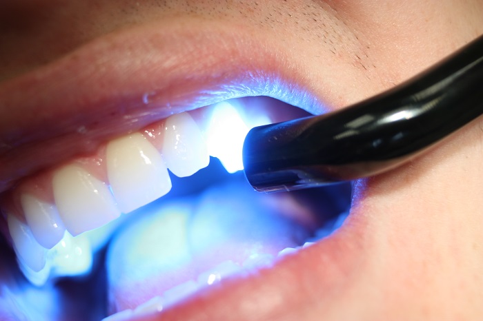 Teeth Whitening in GK1