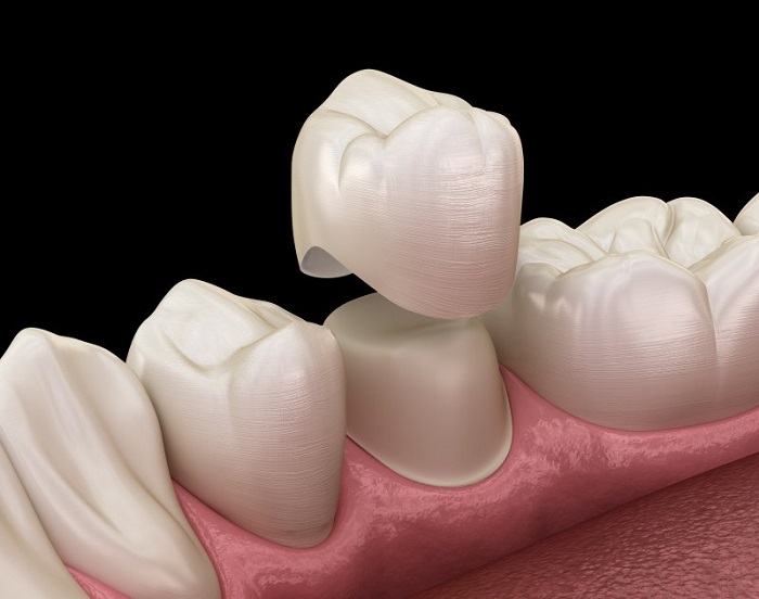 Best replacement crowns in gk1 dental