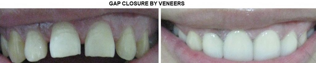 Best veneers in gk1 dental