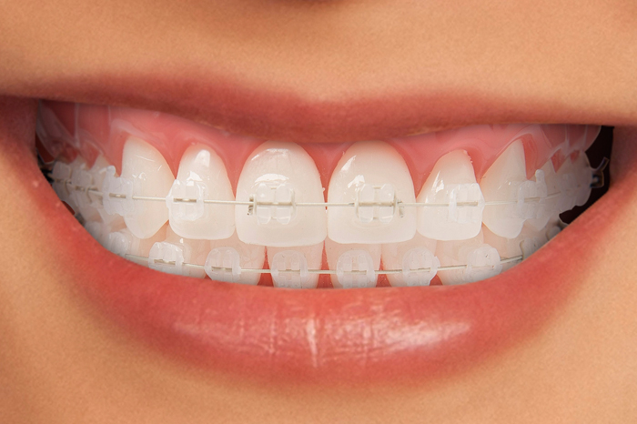 Invisible Braces Treatment GK1 Dental