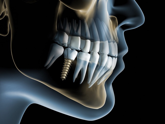 Dental Implants in South Delhi