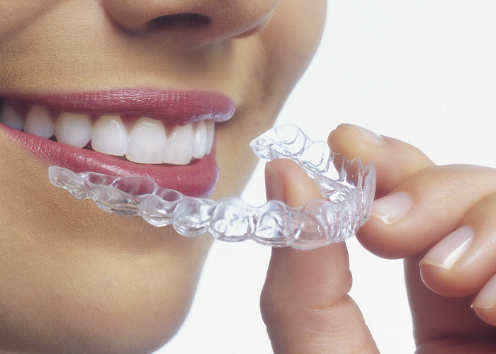 Invisalign Braces in South Delhi