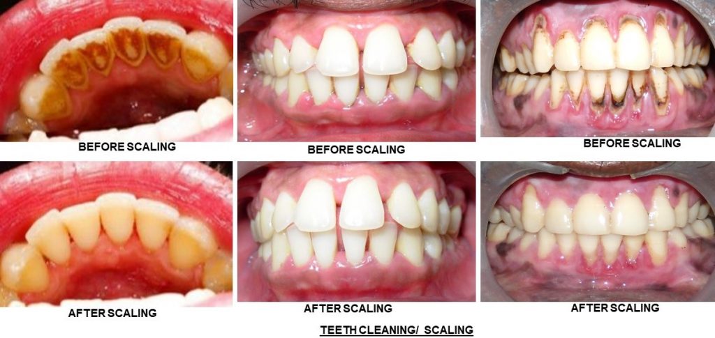 Best scaling in gk1 dental