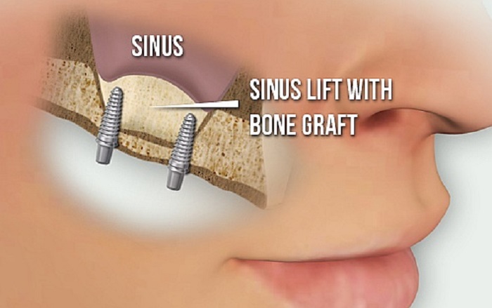 best sinus lift in gk1 dental