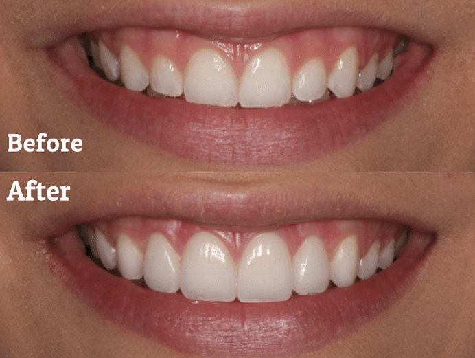 Recontouring Of Teeth in South Delhi