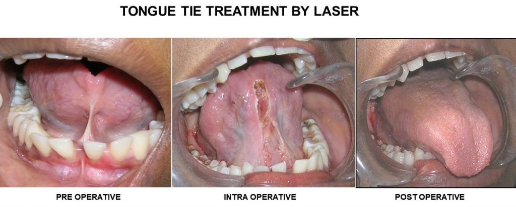 Best tongue tie laser in gk1 dental