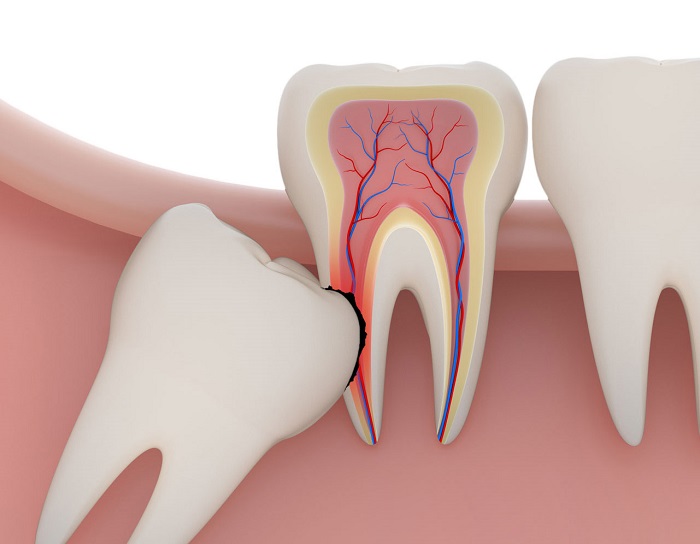 Best wisdom tooth extraction In south delhi