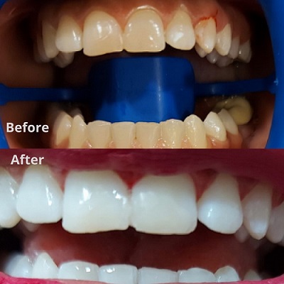 Teeth Whitening in south Delhi