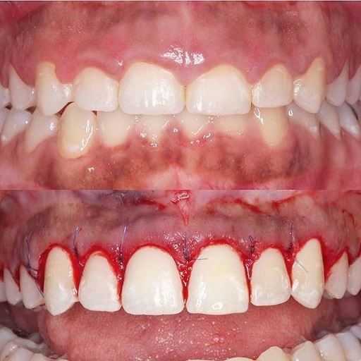Best gummy smile correction using lasertreatment in south delhi