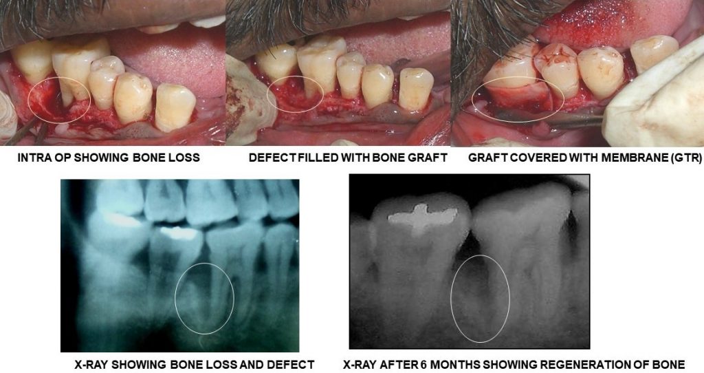 bone grafting